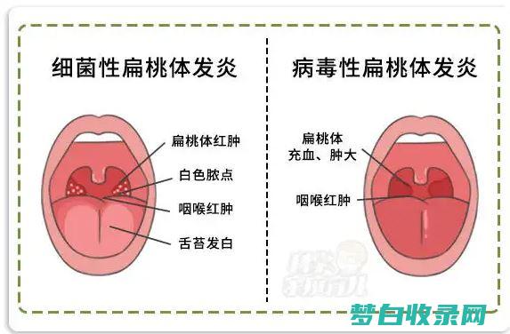 扁桃体发炎最佳药物指南：快速缓解疼痛和感染 (扁桃体发炎最好的治疗方法)