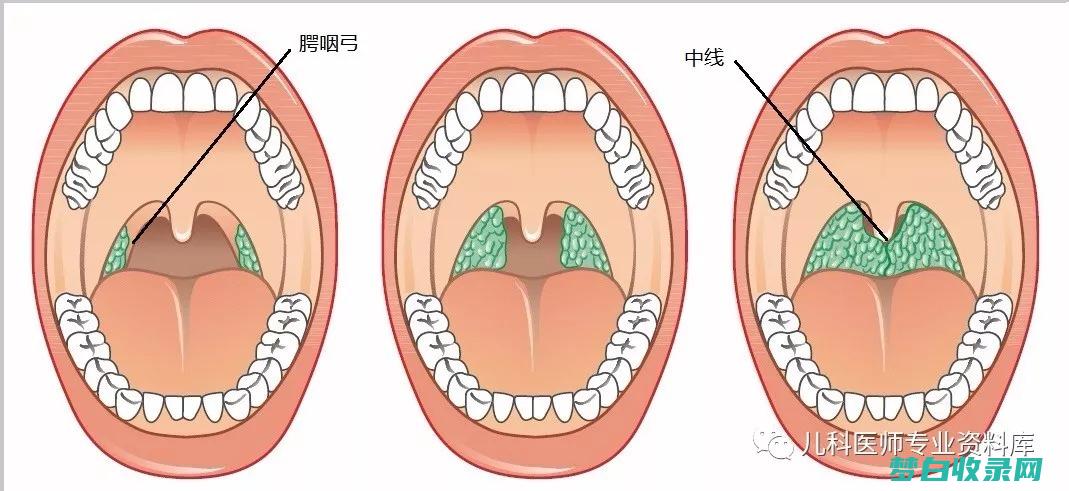 摆脱扁桃体炎的杀手锏：揭秘最有效的药物 (摆脱扁桃体炎的方法)