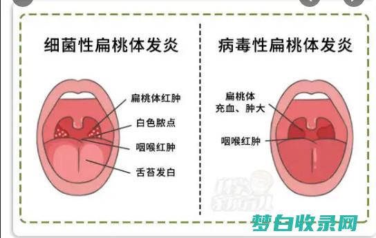 战胜扁桃体发炎：发现最有效的抗生素和止痛药 (缓解扁桃体)